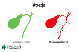 Atrezja