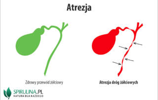 Atrezja