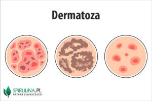 Dermatoza