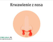Krwawienie z nosa