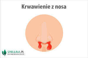 Krwawienie z nosa