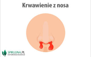 Krwawienie z nosa