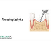 Alweoloplastyka
