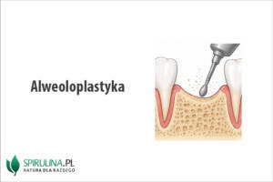 Alweoloplastyka