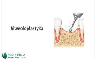 Alweoloplastyka