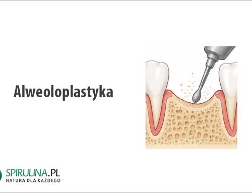 Alweoloplastyka