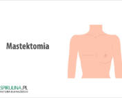 Mastektomia
