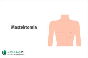 Mastektomia