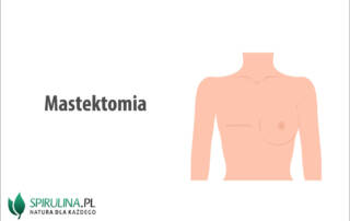 Mastektomia