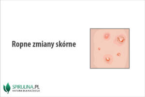 Ropne zmiany skórne