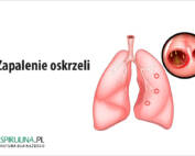 Zapalenie oskrzeli