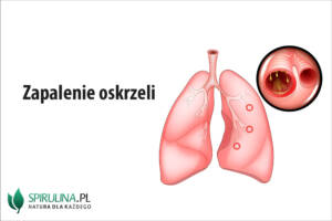 Zapalenie oskrzeli